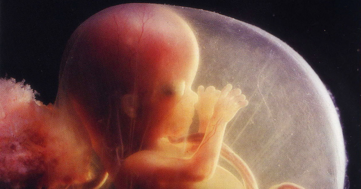 Фото ребенка 13 недель. Зародыш в зародыше аномалия. Эмбрион на 13 неделе беременности. Патология беременности.